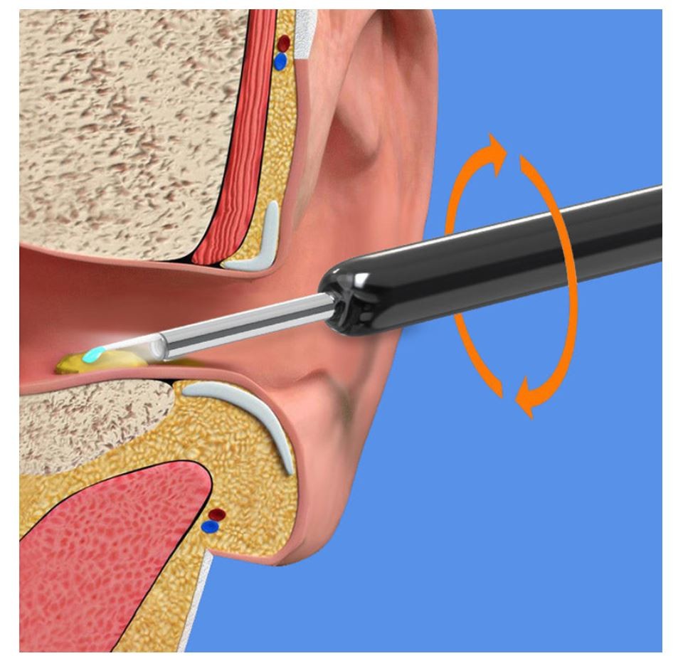 HD Earwax Removal Kit – See Clearly, Clean Gently